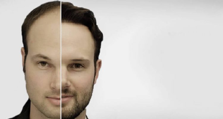 Is it possible to get hair transplant treatment on scar tissue?