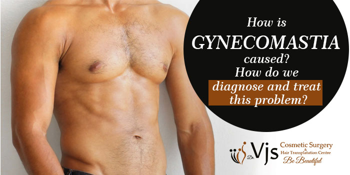 How is gynecomastia caused? How do we diagnose and treat this problem?