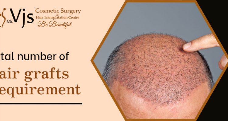 How much is the total number of hair grafts you need for your hair loss?