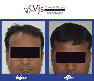Best hair transplant in Vizag, Visakhapatnam, Andhra Pradesh