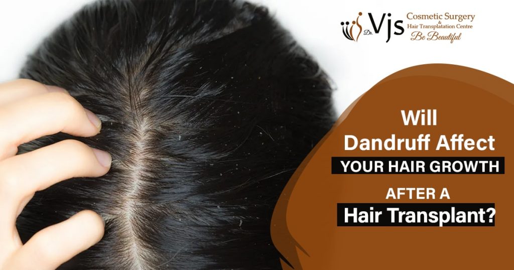 Will-dandruff-affect-your-hair-growth-after-a-hair-transplant