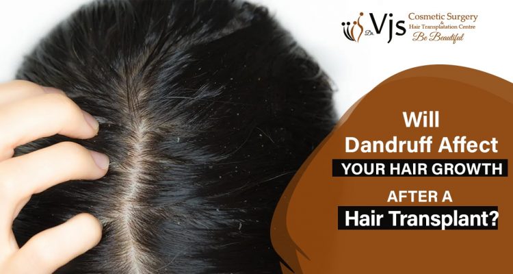 Hair Transplant Surgery: Can It Help To Address The Dandruff Problem?