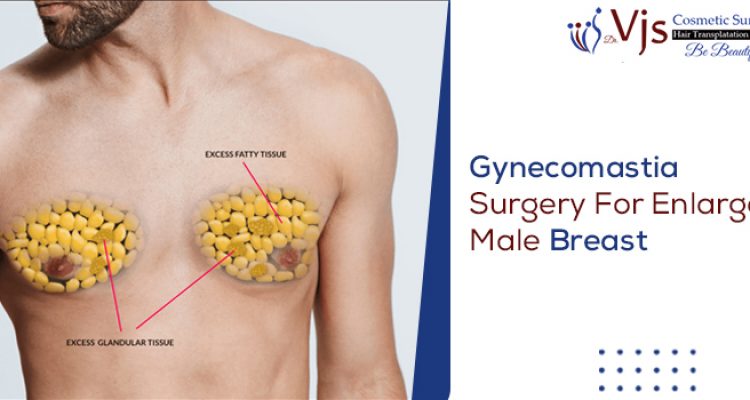 3 Ways For Speedy Recovery From Gynecomastia Surgery In Vizag