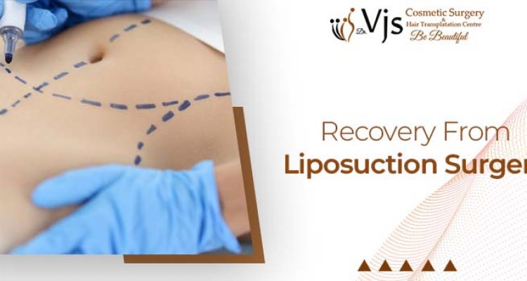 Cosmetic Treatment: How is it like to recover from liposuction surgery?